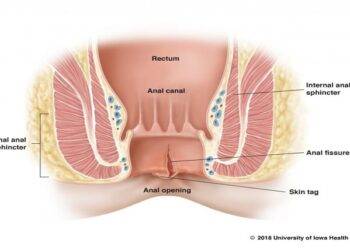 Anal Fissures: Diagnosis & Natural Treatments