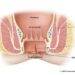 Anal Fissures: Diagnosis & Natural Treatments