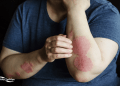 Comprehensive Diagnostic and Psoriasis Treatment Options in Turkey