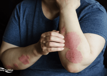 Comprehensive Diagnostic and Psoriasis Treatment Options in Turkey