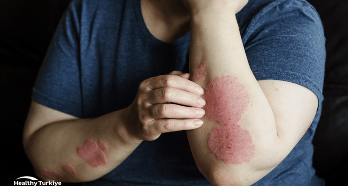 Comprehensive Diagnostic and Psoriasis Treatment Options in Turkey