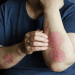 Comprehensive Diagnostic and Psoriasis Treatment Options in Turkey